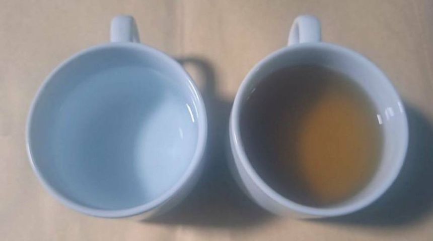 Suy thận cấp vì uống trà đặc thay nước lọc suốt hàng chục năm