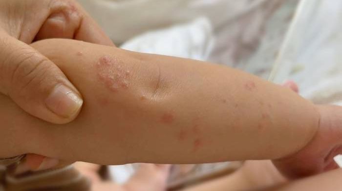 5 dấu hiệu dễ bị hiểu nhầm khi trẻ mắc tay chân miệng