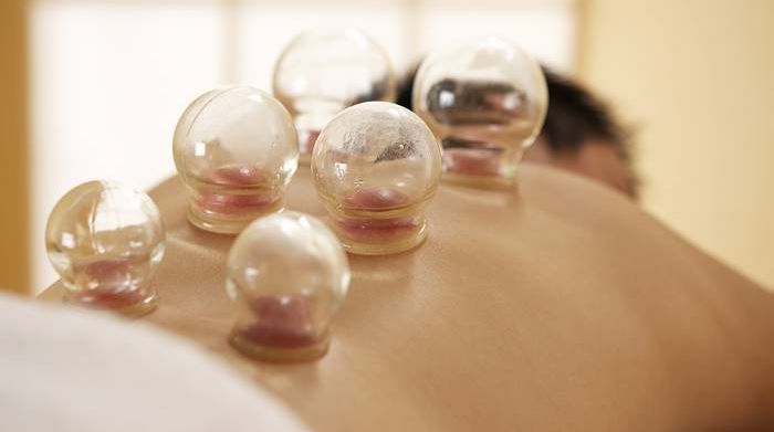 Giác hơi hút máu chữa được đột quỵ?