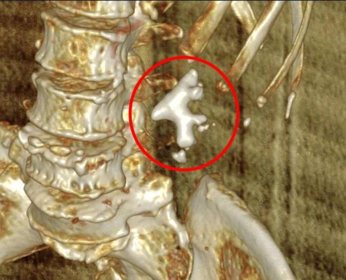 Hình chụp CT cho thấy sỏi san hô kích thước lớn chiếm phần lớn bể thận trái của bà Hiền. Ảnh: Bệnh viện Đa khoa Tâm Anh