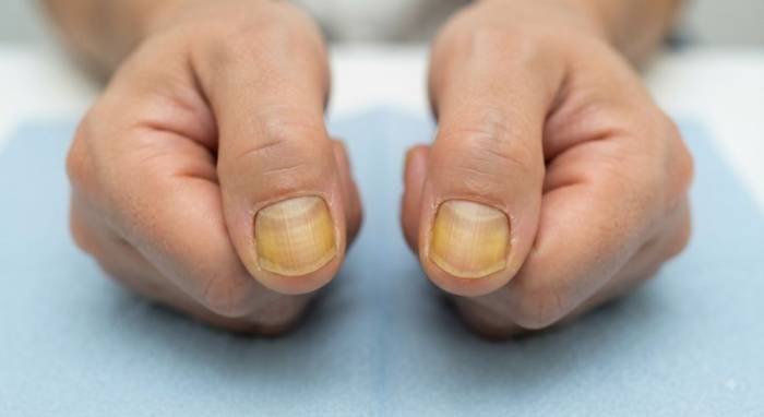 Móng tay chuyển vàng bất thường là dấu hiệu bệnh lý. Ảnh: AI