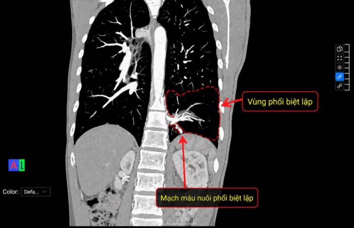 Ảnh chụp CT phổi cho thấy vùng phổi biệt lập ở thùy dưới phổi trái, mạch máu nuôi phổi biệt lập xuất phát từ động mạch chủ bụng. Ảnh: Bệnh viện Đa khoa Tâm Anh