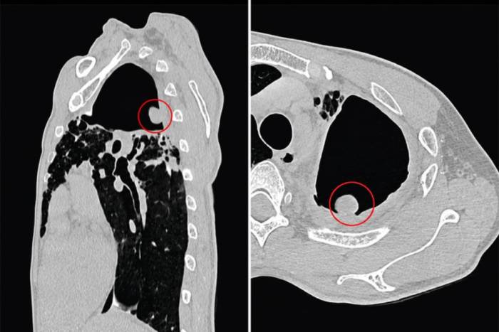 Khối u nấm phổi xuất hiện trên hình CT. Ảnh: Bệnh viện Đa khoa Tâm Anh