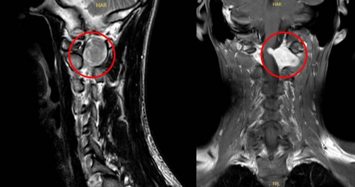 Kết quả chụp MRI cho thấy khối u to chèn ép tủy cổ. Ảnh: Bệnh viện Đa khoa Tâm Anh