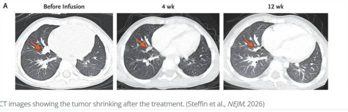 Hình ảnh chụp CT cho thấy khối u đã thu nhỏ lại sau điều trị. Ảnh: NEJM