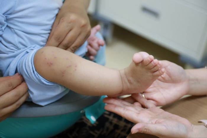 Trẻ mắc tay chân miệng xuất hiện nhiều bóng nước ở chân - triệu chứng thường gặp. Ảnh: Bệnh viện Đa khoa Tâm Anh Quận 8