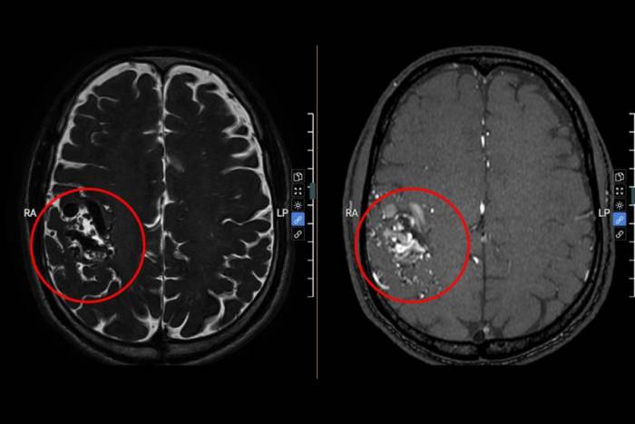 Hình ảnh MRI cho thấy một ổ dị dạng mạch máu lớn ở thùy trán. Ảnh: Bệnh viện Đa khoa Tâm Anh