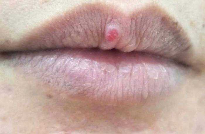 Vùng tổn thương trên môi chị Hương trước điều trị. Ảnh: Bệnh viện Đa khoa Tâm Anh