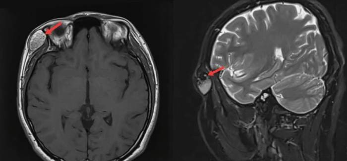 Hình chụp MRI khối u bất thường bên mi mắt phải của chị Dương. Ảnh: Bệnh viện Đa khoa Tâm Anh
