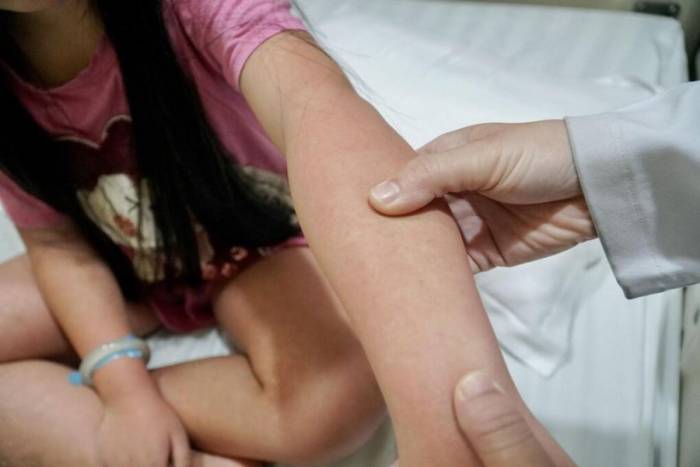 Các nốt ban đỏ xuất hiện trên cánh tay bé Minh Anh trong thời gian mắc sốt xuất huyết. Ảnh: Bệnh viện Đa khoa Tâm Anh