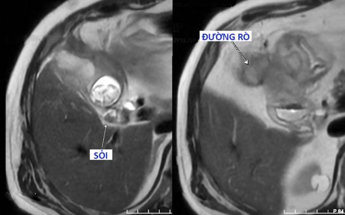 Sỏi túi mật và đường rò dạ dày trên phim MRI của ông Luân. Ảnh: Bệnh viện Đa khoa Tâm Anh