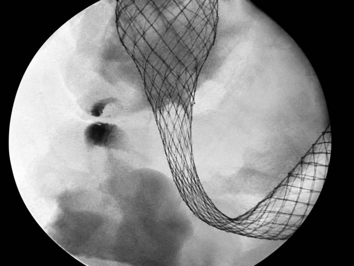 Stent kim loại được bác sĩ đặt vào chỗ tắc đại tràng. Ảnh: Bệnh viện cung cấp