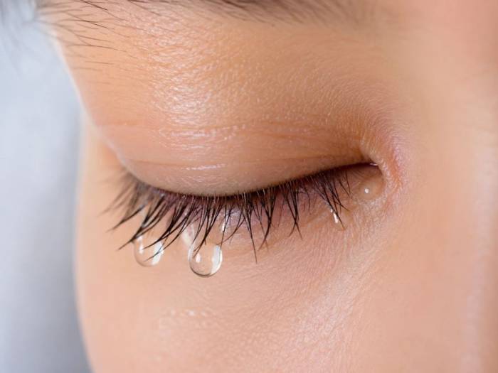 Bệnh tuyến giáp có thể gây ra sưng quanh mắt và sụp mí trên kèm chảy nước mắt. Ảnh minh họa: AI