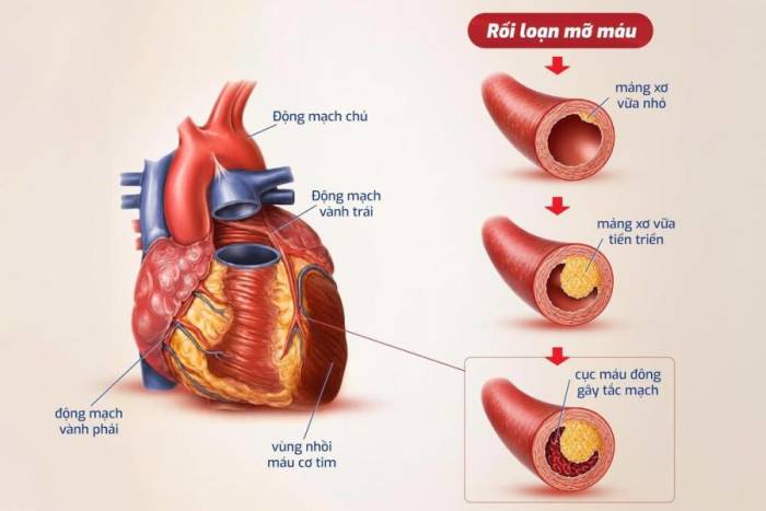 Mảng xơ vữa do rối loạn mỡ máu gây hẹp, tắc động mạch vành, dẫn đến thiếu máu cơ tim, nhồi máu cơ tim. Ảnh: Dược phẩm Eco