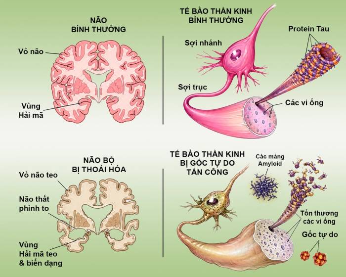 Mô tả não bình thường và não bị gốc tự do tấn công làm biến dạng sợi tau và hình thành mảng amyloid. Ảnh: Dược phẩm Eco