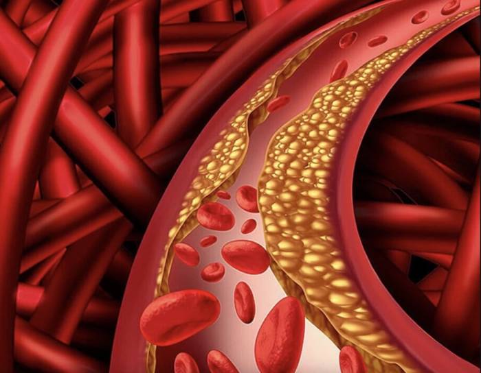 Minh họa cholesterol tích tụ trong máu. Ảnh: My Health My Life