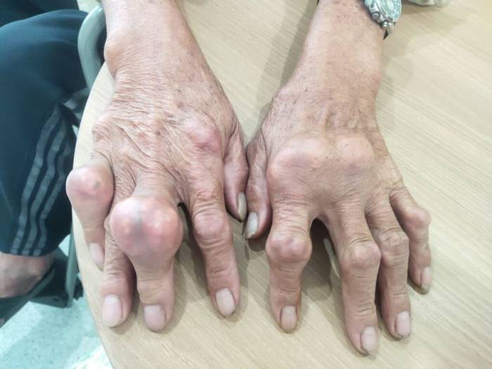 Người bệnh nổi nhiều u ở khớp ngón tay, bàn tay do gout chuyển nặng. Ảnh: Phòng khám Đa khoa Tâm Anh Quận 7