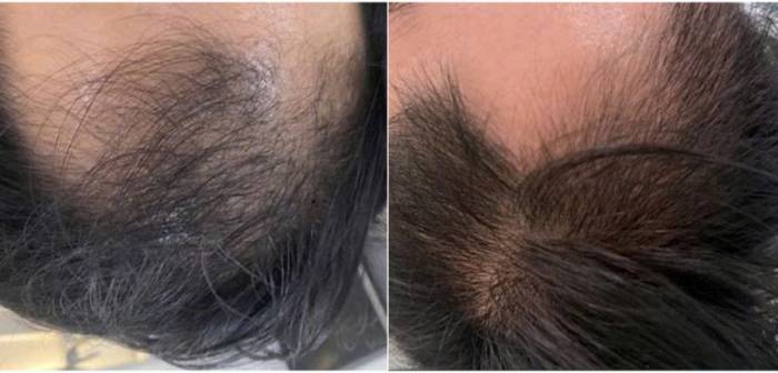 Tóc của Hùng đã mọc lại nhiều hơn sau 3 lần kết hợp tiêm PRP và laser. Ảnh: Bệnh viện Đa khoa Tâm Anh