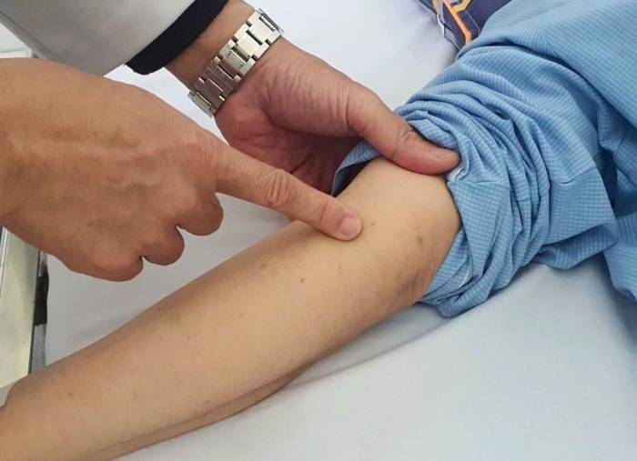 Ban xuất huyết hoại tử trên da bệnh nhân mắc não mô cầu. Ảnh:Nguyên Hà