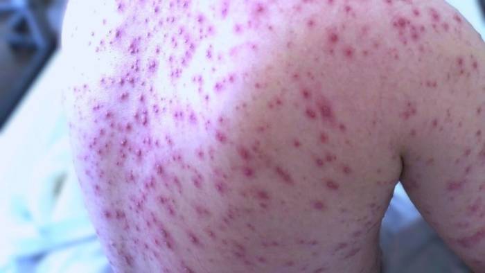 Bệnh nhân thủy đậu có thể mắc tới 500 nốt mụn nước trên da. Ảnh: Bệnh viện Đa khoa Tâm Anh