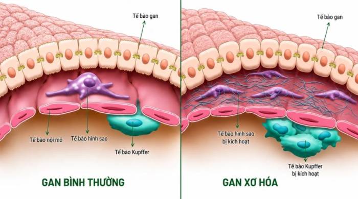Mô gan bình thường và mô gan xơ hóa do tế bào kupffer bị kích hoạt quá mức. Ảnh: Dược phẩm Eco