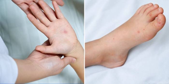 Mụn nước xuất hiện ở bàn tay, bàn chân của trẻ mắc tay chân miệng. Ảnh: Bệnh viện Đa khoa Tâm Anh