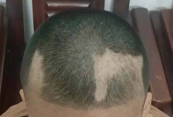 Bệnh nhi nhổ tóc khiến cả mảng đầu trắng, dù đã được cắt ngắn. Ảnh: Bác sĩ cung cấp