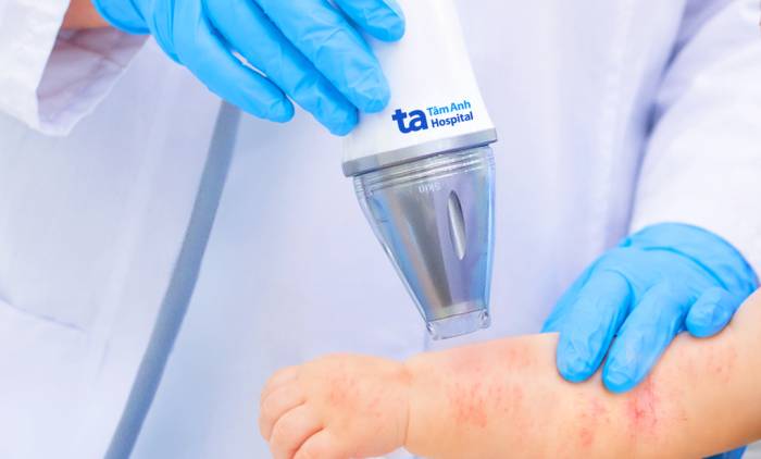 Bác sĩ sử dụng máy Plasma Gold giúp giảm ngứa, kích ứng trong quá trình điều trị các bệnh viêm da cho trẻ. Ảnh minh họa: Phòng khám Đa khoa Tâm Anh Quận 7