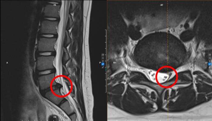Vị trí khối thoát vị chèn ép thần kinh của Nam trên phim chụp MRI. Ảnh: Bệnh viện Đa khoa Tâm Anh