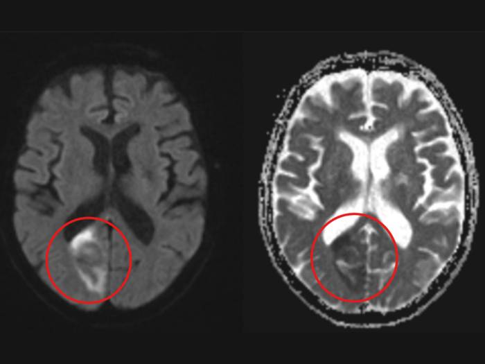 Hình ảnh MRI ghi nhận ông Định có nhồi máu não. Ảnh: Bệnh viện Đa khoa Tâm Anh