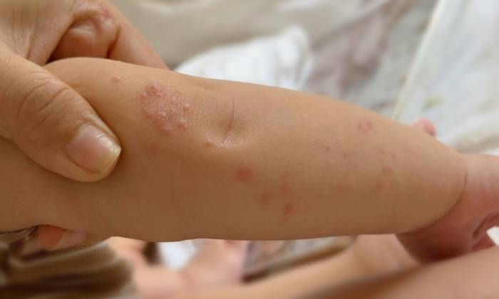 Bệnh tay chân miệng ở trẻ có thể dễ nhầm với rôm sảy hoặc một số bệnh ngoài da khác. Ảnh: An Hy