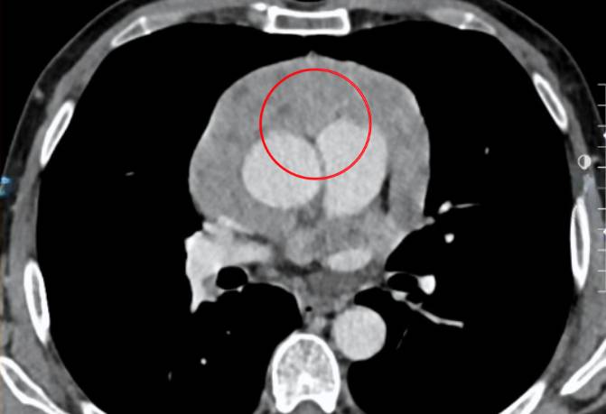 Ảnh CT cho thấy khối u tuyến ức (khoanh đỏ) chèn ép tim người bệnh. Ảnh: Bệnh viện Đa khoa Tâm Anh