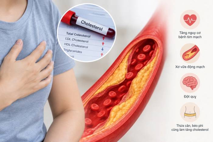 Cholesterol cao làm tăng nguy cơ mắc bệnh tim mạch. Ảnh: AI