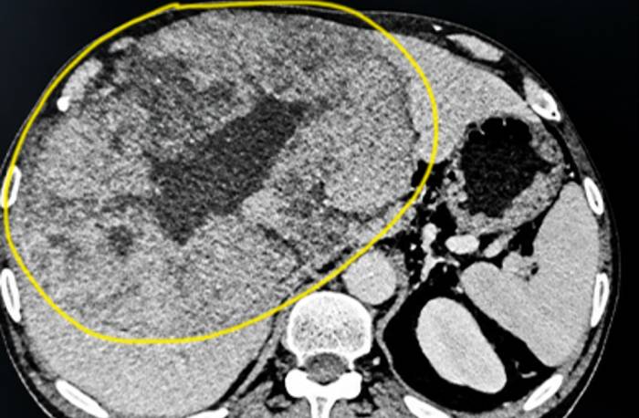 Chụp CT ghi nhận khối u gan chiếm trọn gan phải. Ảnh: Bệnh viện Đa khoa Tâm Anh