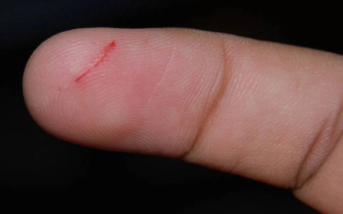 Vết thương nhỏ nhưng lâu lành là điều bạn nên chú ý. Ảnh minh họa: Firstaidpro