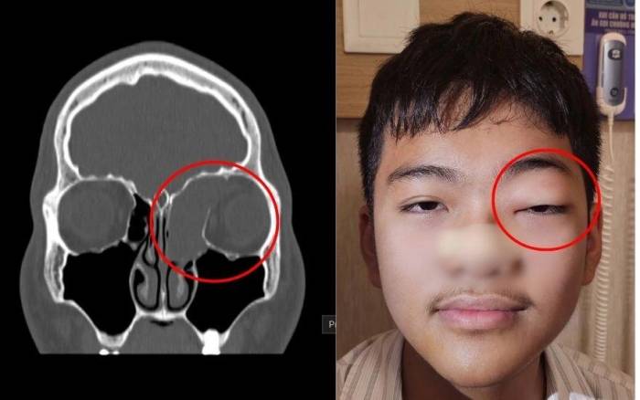Hình ảnh CT cho thấy u nhầy xoang sàng - trán bên trái lan sát ổ mắt, tương ứng với biểu hiện lồi mắt của bệnh nhi. Ảnh: Bệnh viện cung cấp