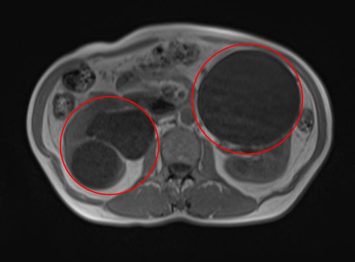 Hình ảnh MRI ghi nhận nhiều nang thận lớn chèn ép hai bên thận của bà Liên. Ảnh: Bệnh viện Đa khoa Tâm Anh