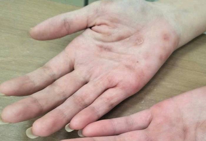 Các nốt đỏ trên bàn tay chị Lan. Ảnh: Bệnh viện Đa khoa Tâm Anh