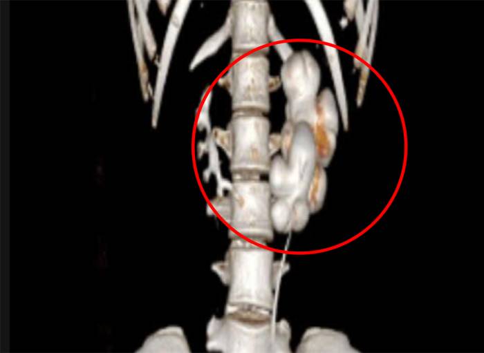 Hình chụp CT cho thấy Linh có dị tật thận móng ngựa với mạch máu vắt ngang niệu quản. Ảnh: Bệnh viện Đa khoa Tâm Anh